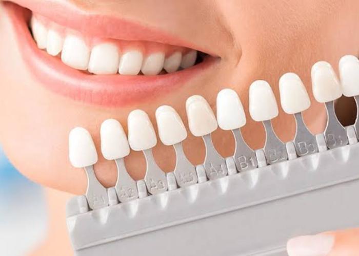 لمینت سرامیکی